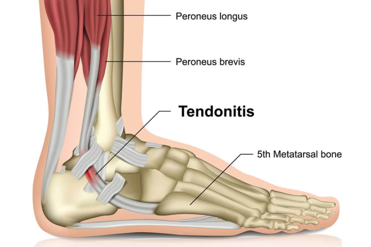 Trail First Aid: How to Treat Common Injuries on a Thru-Hike